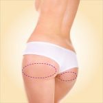 Depilação Meia Nádega a Laser