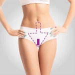 Virilha Cavada c/ Faixa Laser